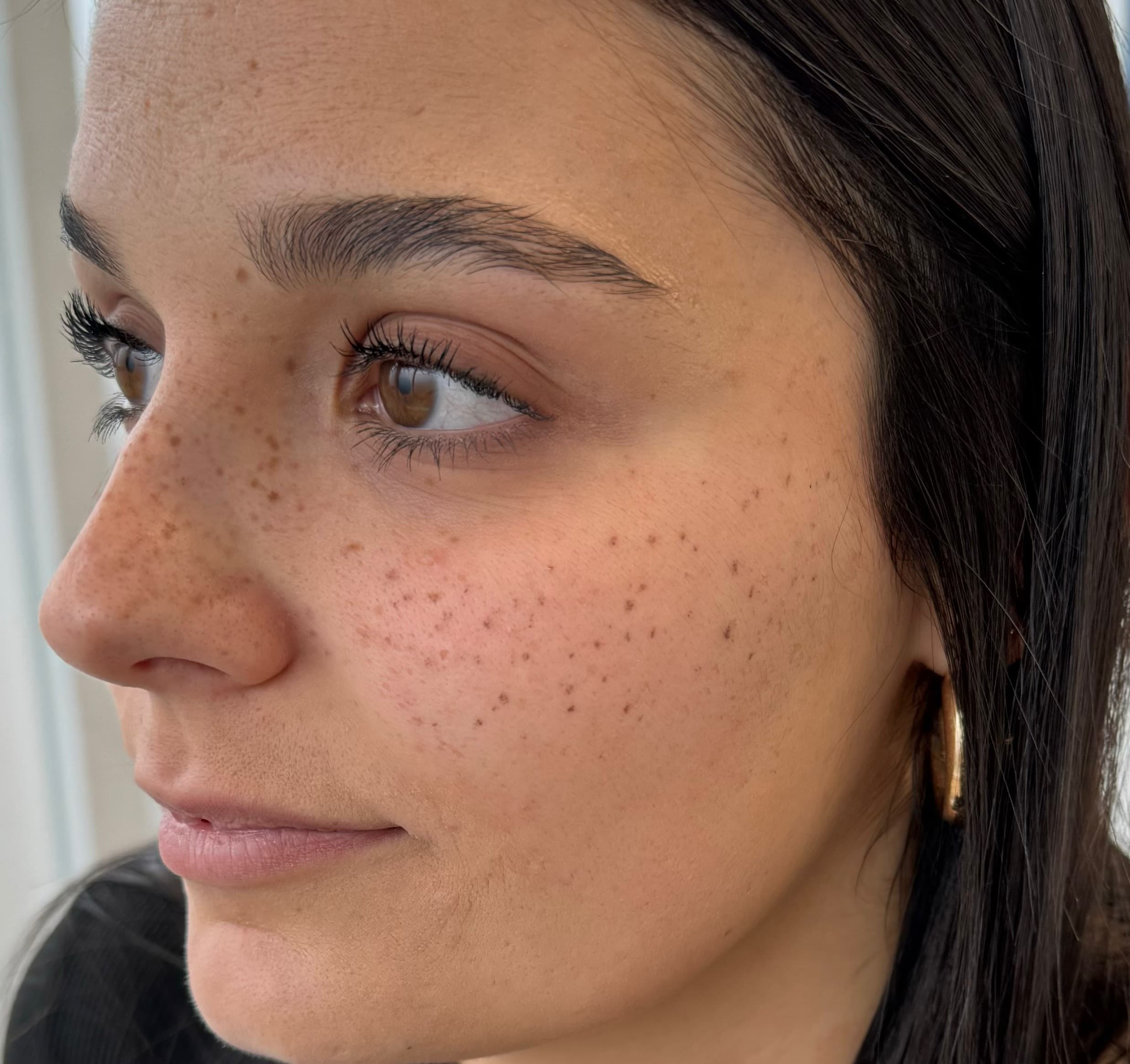 Résultat de dermopigmentation pour créer des fausses taches de rousseur sur le visage, maquillage permanent à Dijon.